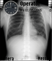 x-ray